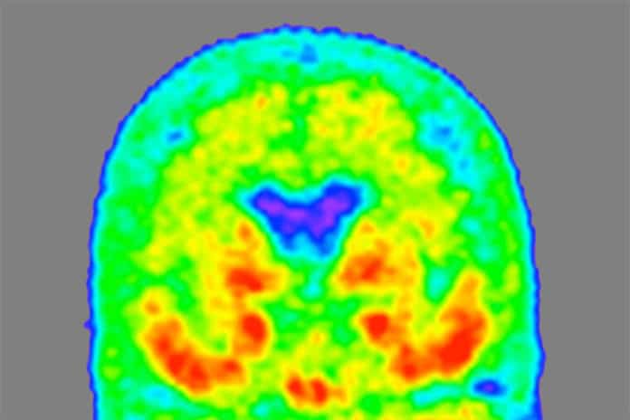 A heat map of the brain of a person