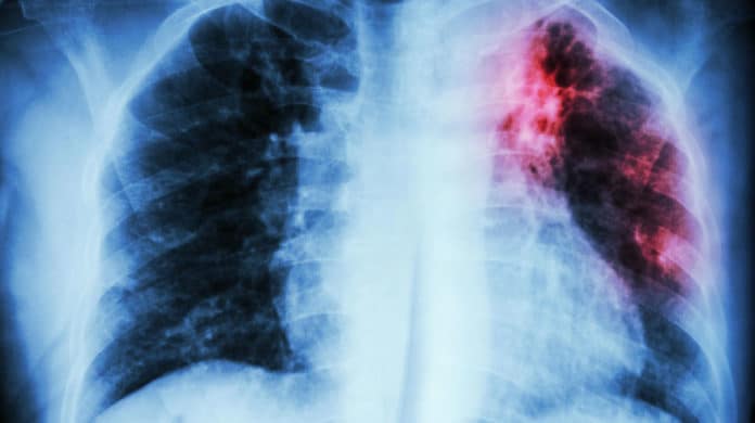 Lung-on-chip uncovered new insight on response to early TB infection