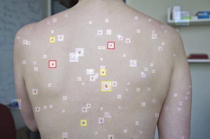 Using wide-field images and deep learning, researchers developed an analysis system of suspicious pigmented skin lesions for more effective and efficient skin cancer detection.