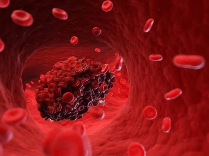 New imaging technique to identify and treat the blood clots