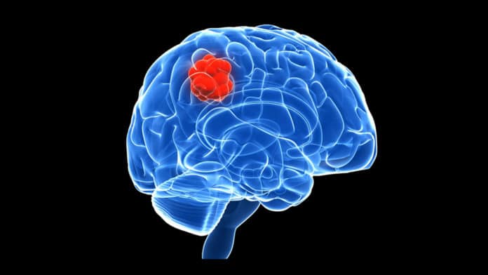 Scientists discovered lymph node-like structures in brain cancer patients