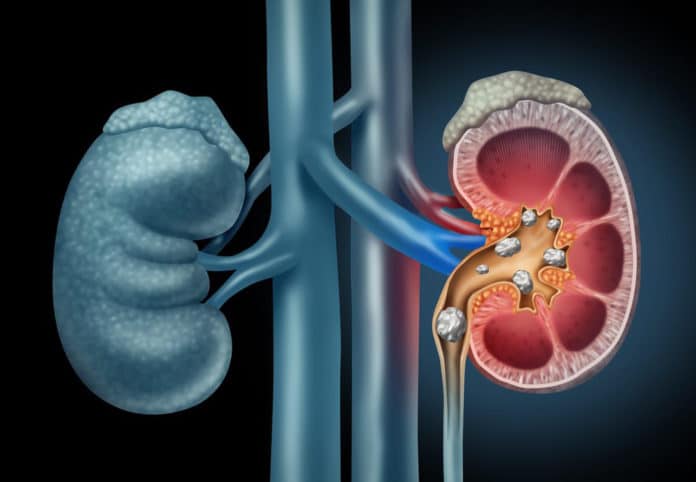 Image showing kidney dysfunction