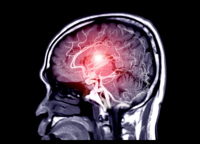 Image showing red dot in brain