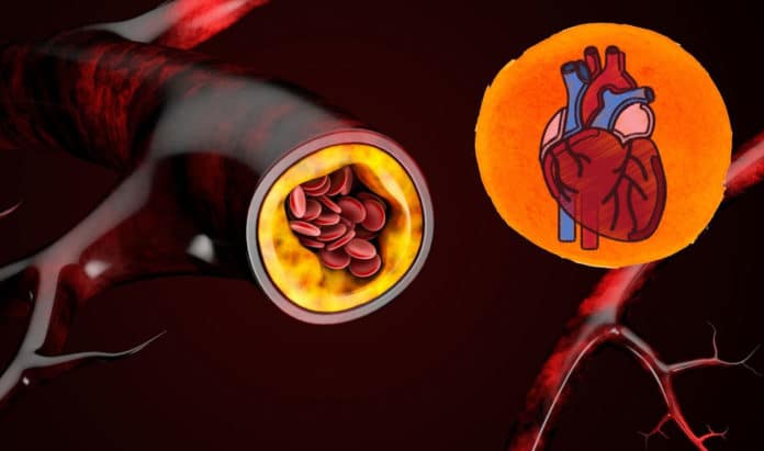 Heart Arteries blockage - atherosclerosis