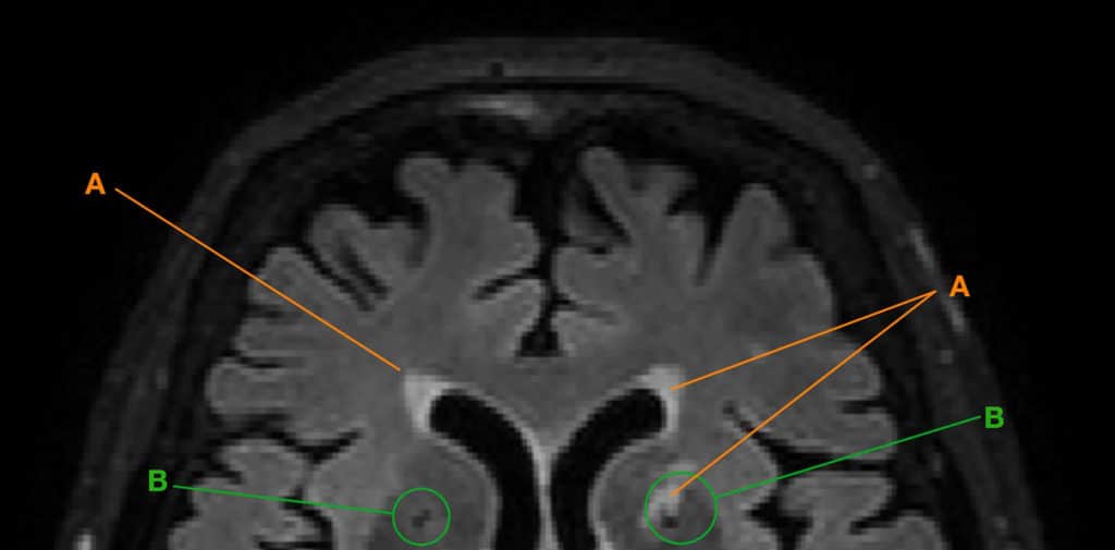 Section of a brain measured by MRI in horizontal section with white matter hyperintensities (A) and lacunae (B). (Image: UZH)
