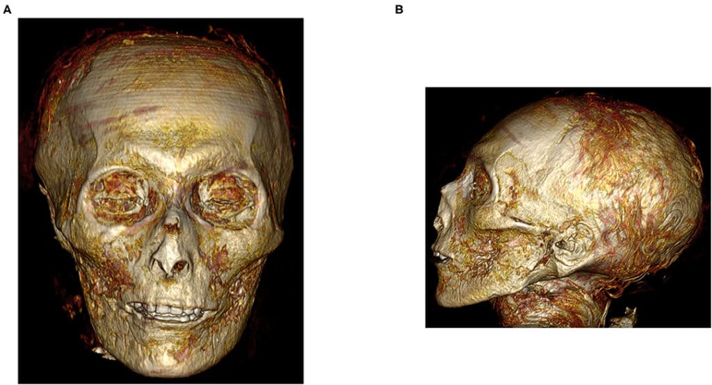 Three-dimensional CT image of the digitally unwrapped face of the mummy Amenhotep I. (A) Three-dimensional CT image of the front of the face of Amenhotep I and (B) Three-dimensional CT image of the left profile of the face of Amenhotep I show an oval face with a narrow chin, small narrow nose flattened by the bandages, mildly protruding upper teeth, sunken eyes, collapsed cheeks, pierced lobule of the left ear, and few coiled hair locks.