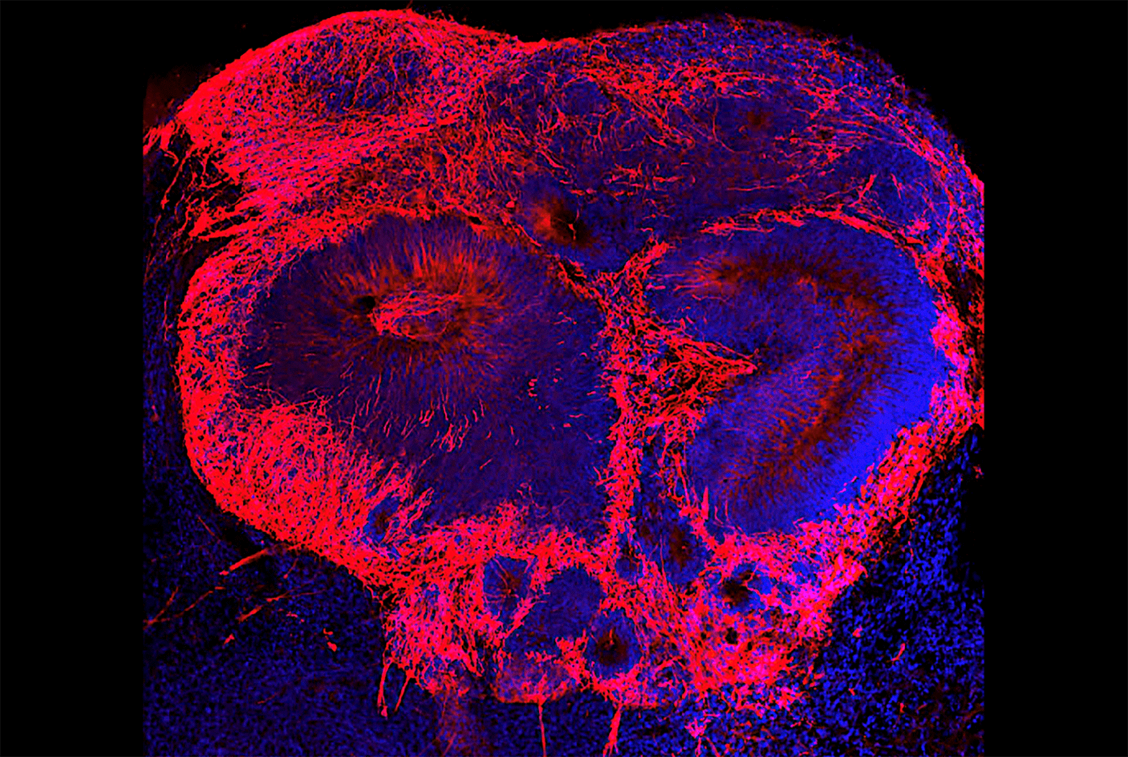 Increasing levels of a potential disease factor results in additional brain cells (red) in a schizophrenia brain organoid. Image courtesy of Dr. Michael Notaras.