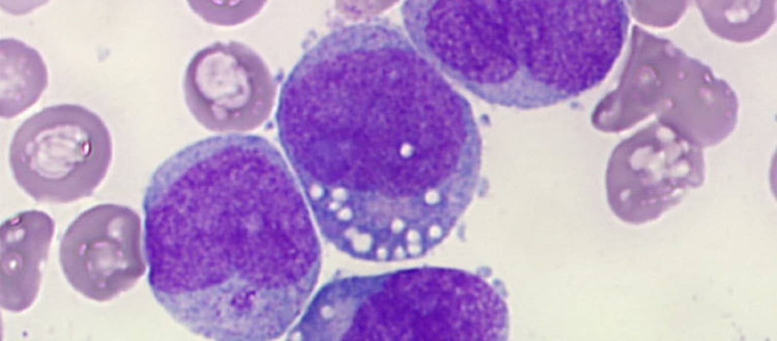 Scientists discovered how to trigger apoptosis in leukemia cells thumbnail