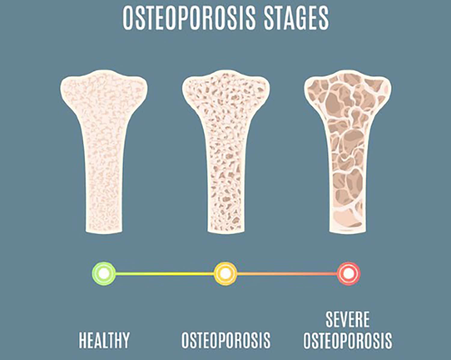 Image showing osteoporosis