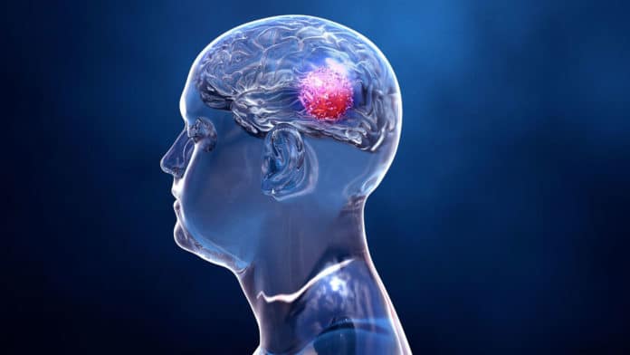 Image showing brain tumor