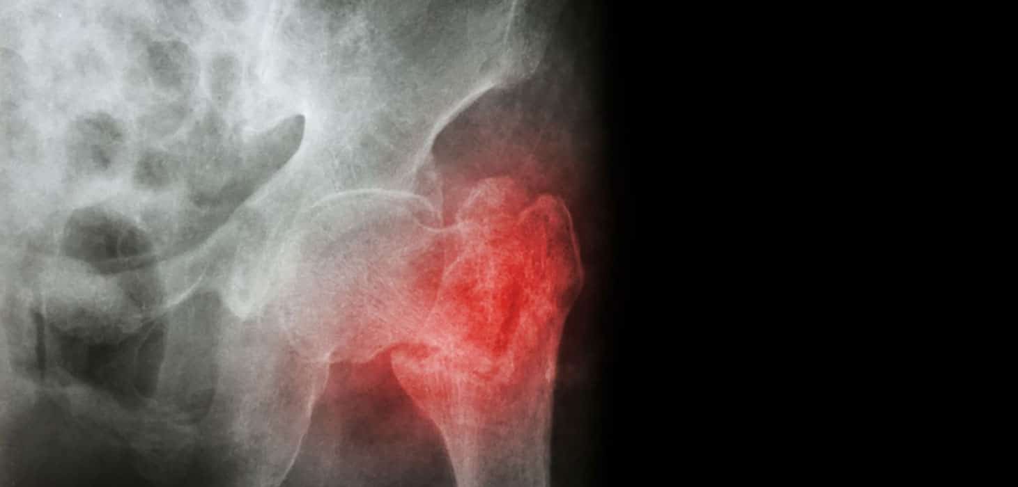 Image showing hip fracture