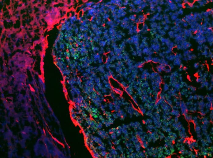 The melanoma-astrocytes interactions