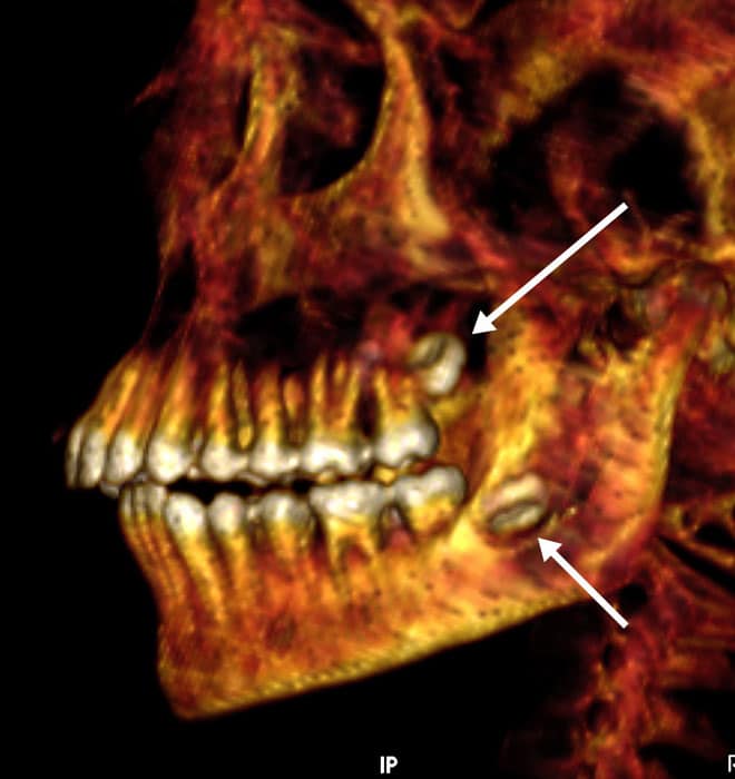 The mummy had protruding teeth