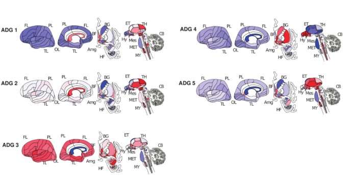 Brain graphic illustrating anatomic patterning of classes ADG 1–5 (5 primary anatomic disease groups).