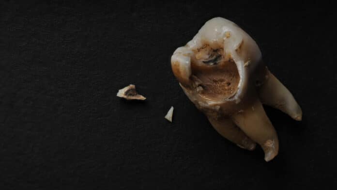 Macro shot of a decayed teeth till root after extraction of dentist.