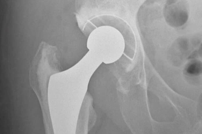 Image showing hip replacement xray.