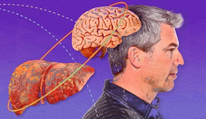 Image showing liver-brain.