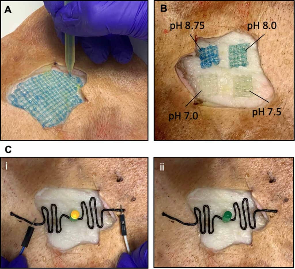 (A) Handheld bioprinting of pH-responsive colorimetric biosensors on an artificially generated pig skin wound. The biosensors allow for real-time detection of bacterial infection by changing color (B) from clear (healthy skin) to blue (infected skin). (C) (i-ii) Conductive hydrogel fibers bioprinted on an artificially generated pig skin wound illuminating an LED when voltage is applied to the fibers.