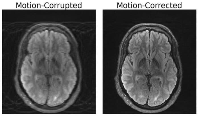 MRI scan of the human brain