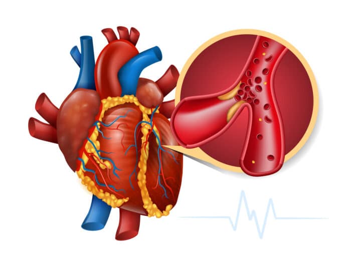 Image showing Myocardial infarction