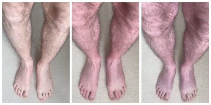 Image showing Blue legs Symptom.