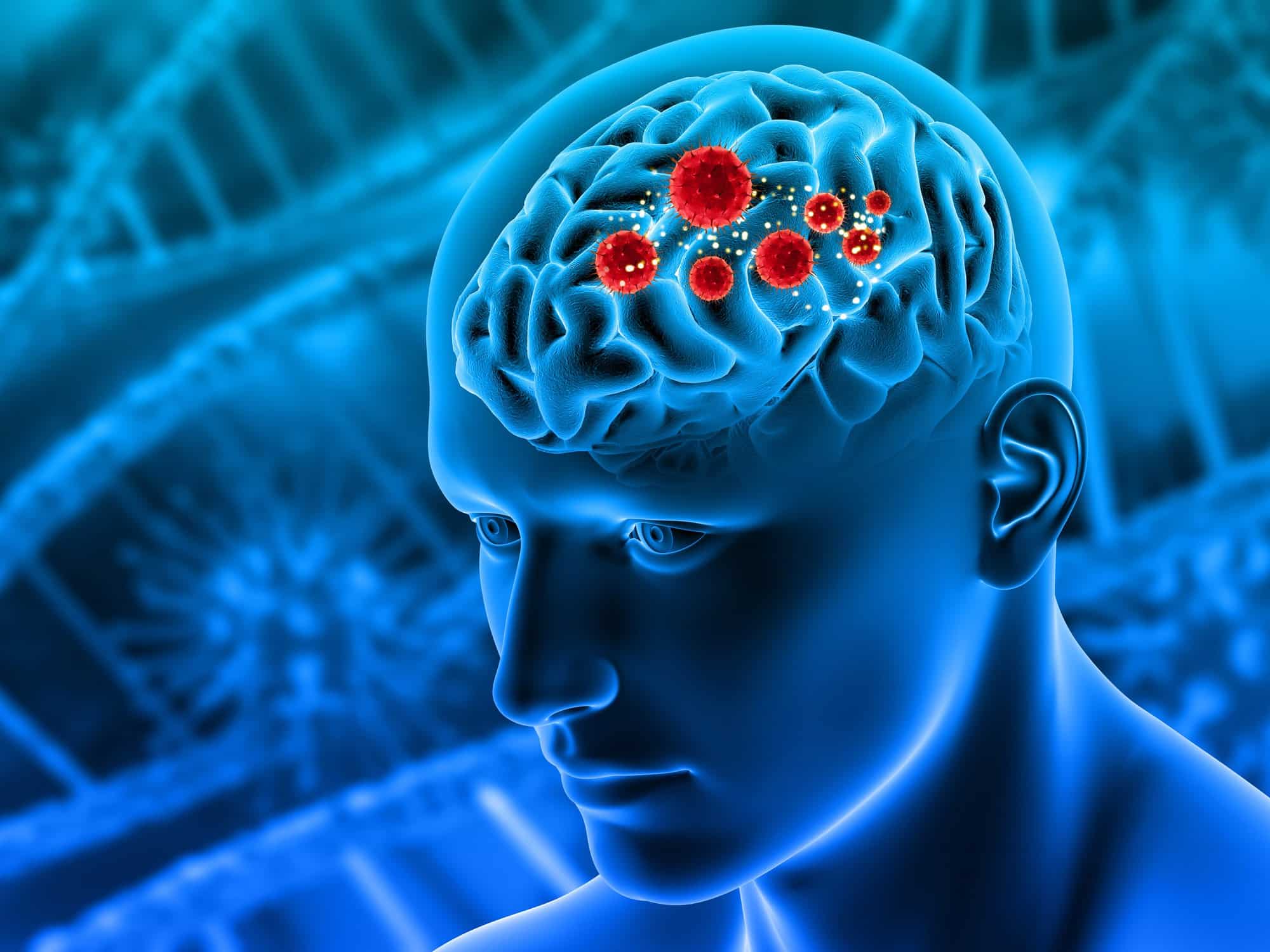 Image showing brain cancer