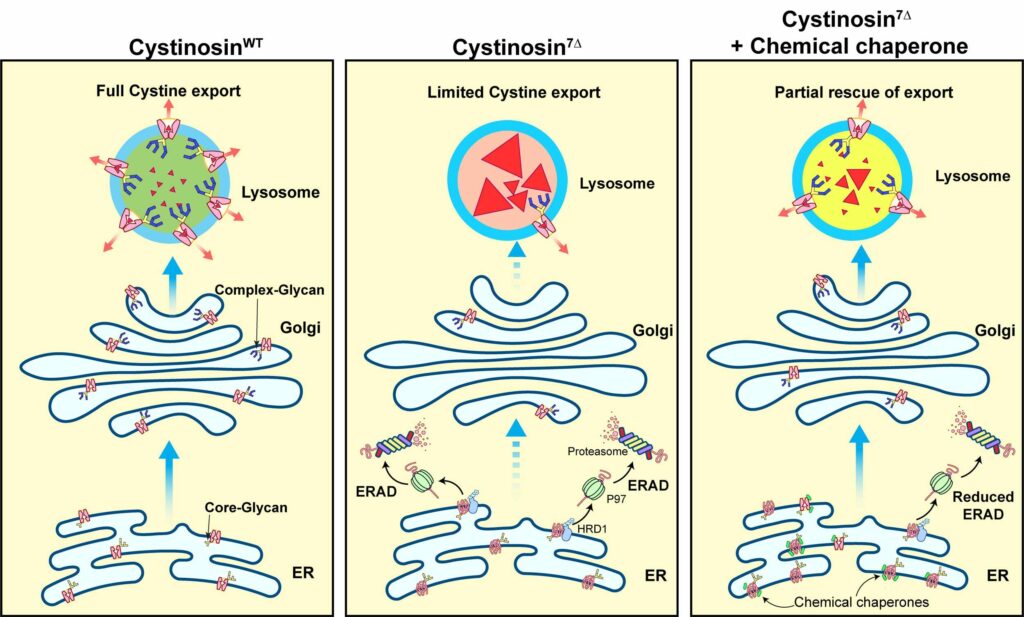 Image showing In a healthy lysosome, transporter proteins are able to move cystine, an amino acid, out of the organelle (left). In a patient afflicted with cystinosis, mutated cystine transporters are degraded by a cellular mechanism that degrades damaged proteins, called endoplasmic-reticulum-associated degradation. Consequently, the lysosome is unable to remove amino acid from the organelle, causing a build-up of cystine (center). Using a chemical chaperone also used to treat a form of cystic fibrosis, University of Michigan researchers were able to protect the mutated lysosome cystine transporter from degradation (right). The chemical chaperones aided in clearing cystine from the lysosome.
