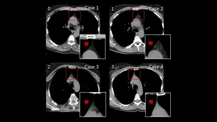 Image showing Thymic soft tissue is light, whereas fat tissue is dark in CT scan images. The image shows varying degrees of fatty degeneration of the thymus, from complete fatty degeneration (0) to mostly intact thymic soft tissue (3).