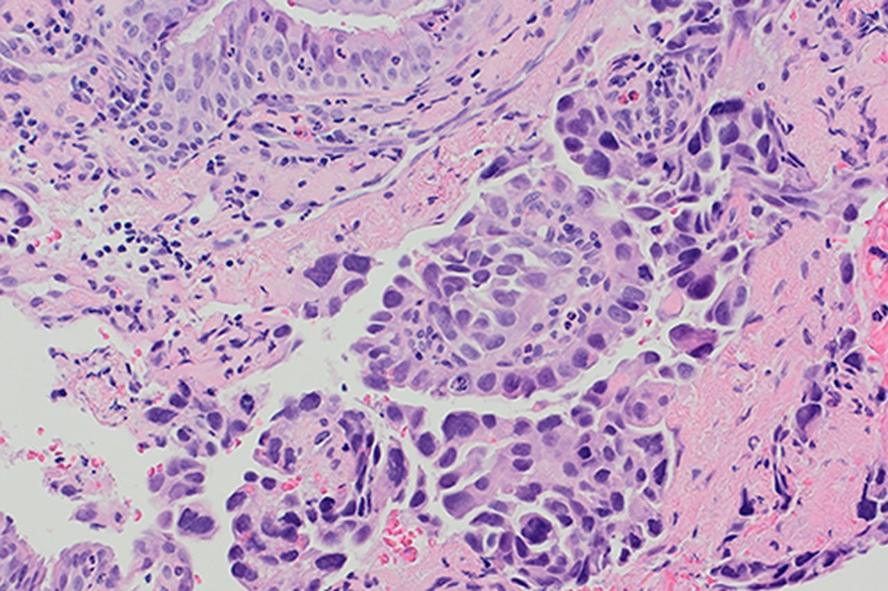 Image showing Non-small cell lung cancer (NSCLC) invading bronchial epithelium.