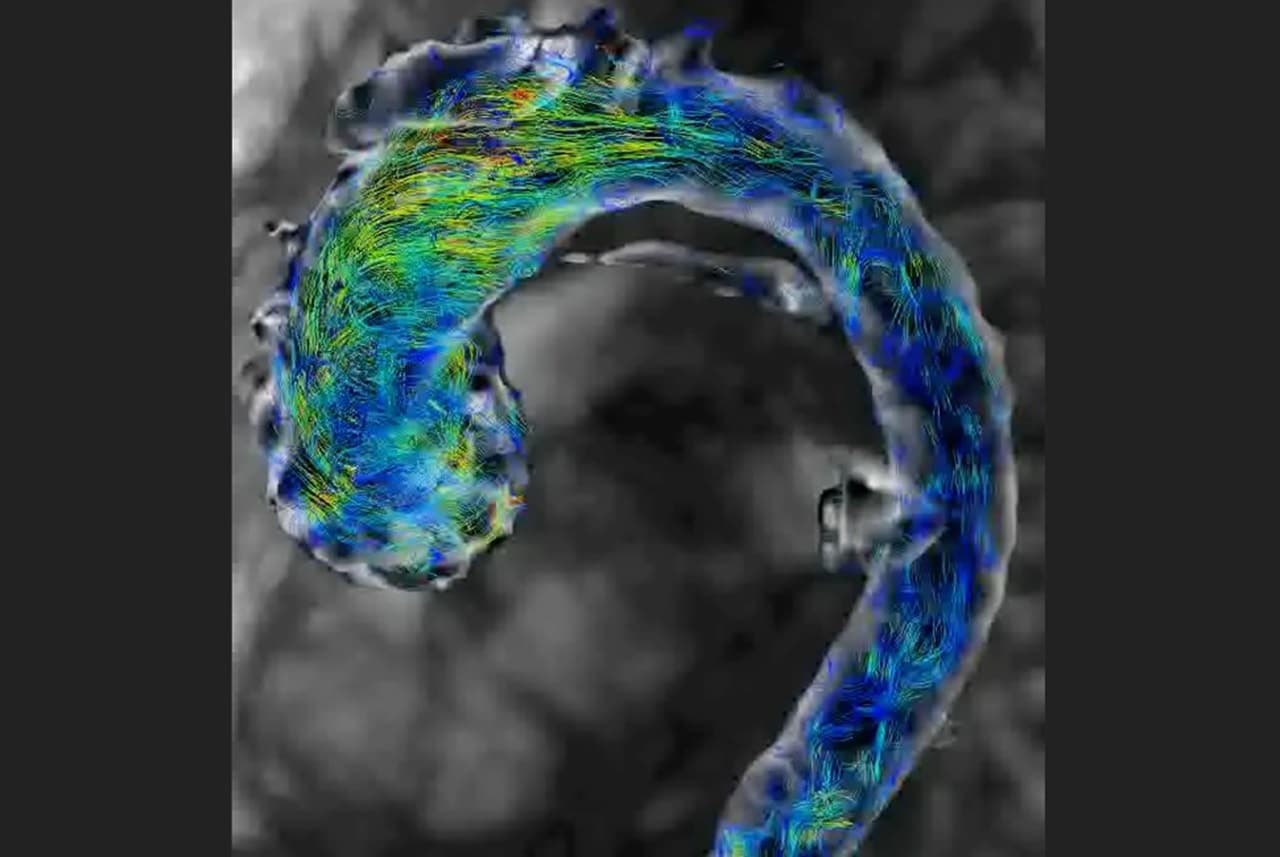 Image showing A 4D flow MRI scan of a human aorta.