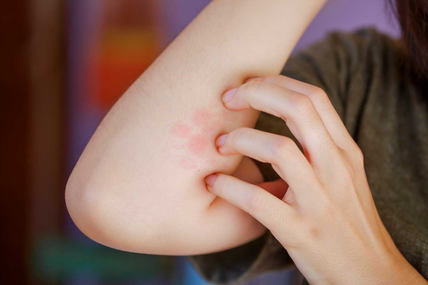 A woman is scratching a red blistered arm