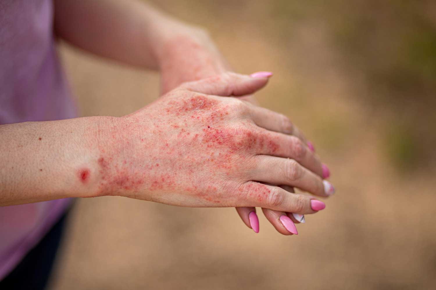 Close up dermatitis on skin ill allergic rash eczema skin of patient atopic dermatitis symptom skin detail texture
