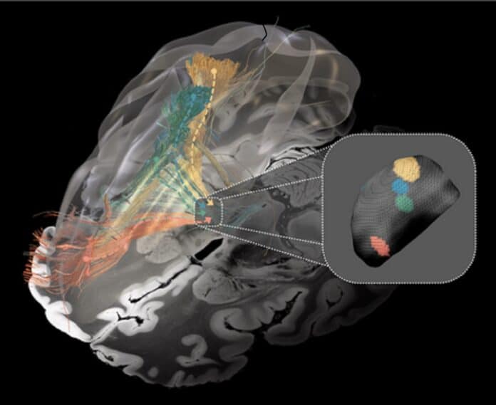 image showing Affected brain circuits in Parkinson’s disease (green), dystonia (yellow), Tourette’s syndrome (blue), and obsessive-compulsive disorder (red). Inset: the optimal target areas for deep brain stimulation in the basal ganglia.