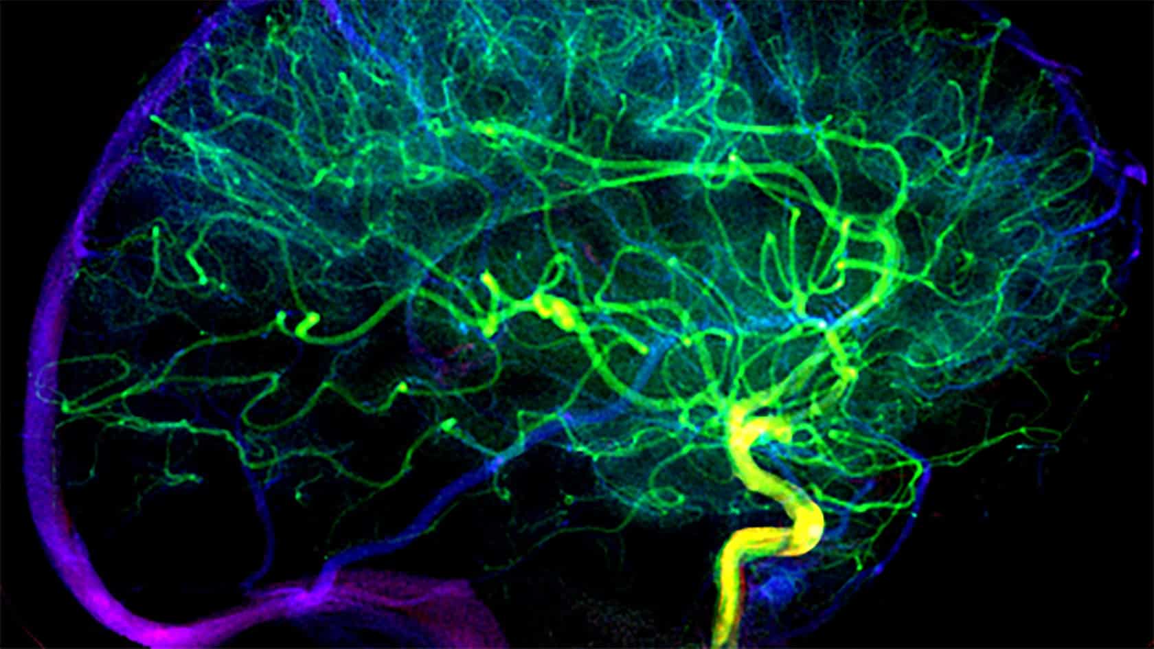 Image showing Visualization of the blood vessels in the brain of a patient without early venous filling, meaning without excessive reperfusion of the brain area after removal of the blood clot in the blocked artery.