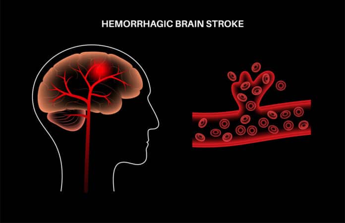 Brain stroke hemorrhagic
