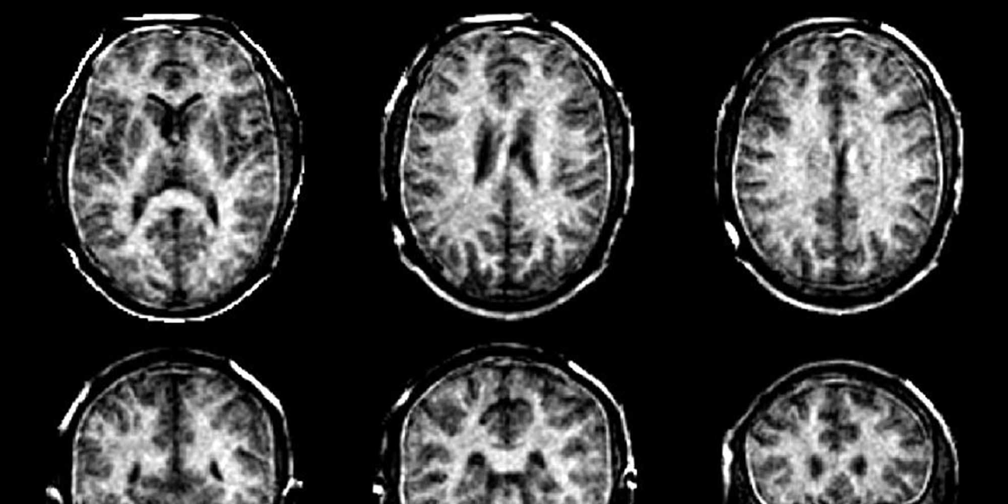 Improved MRI scans of the myelin sheaths in the brain should allow multiple sclerosis to be detected at an early stage