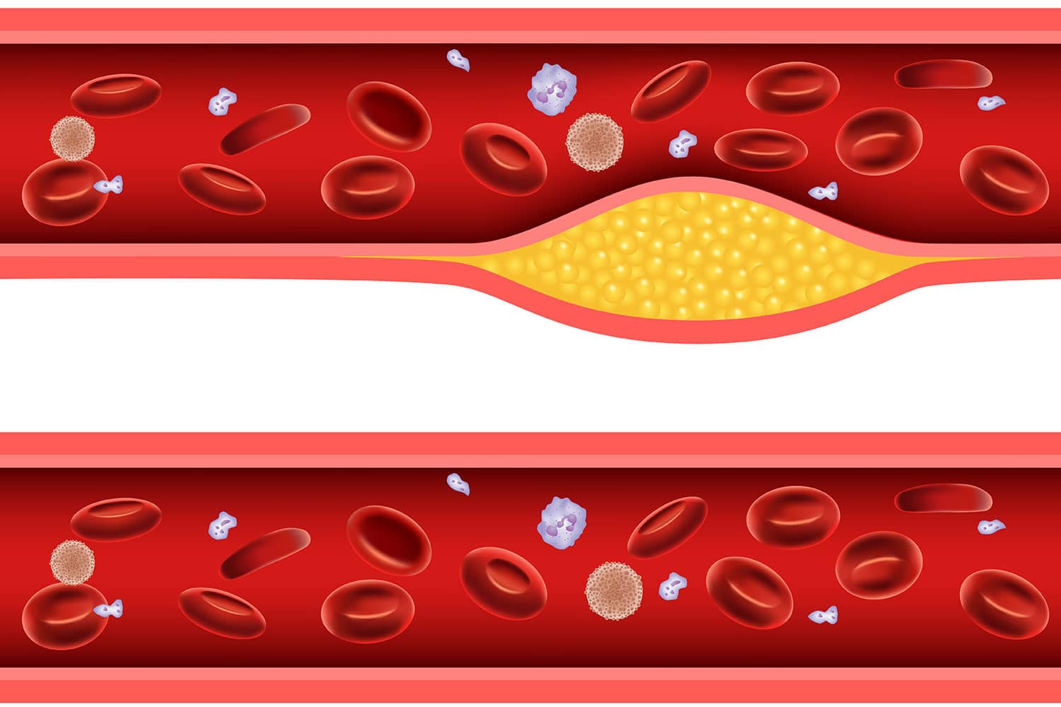 Illustration of artery blocked with bad cholesterol anatomy