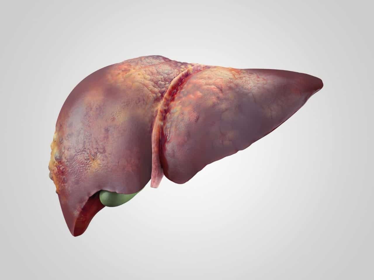 Image showing sick human liver with cancer isolated.