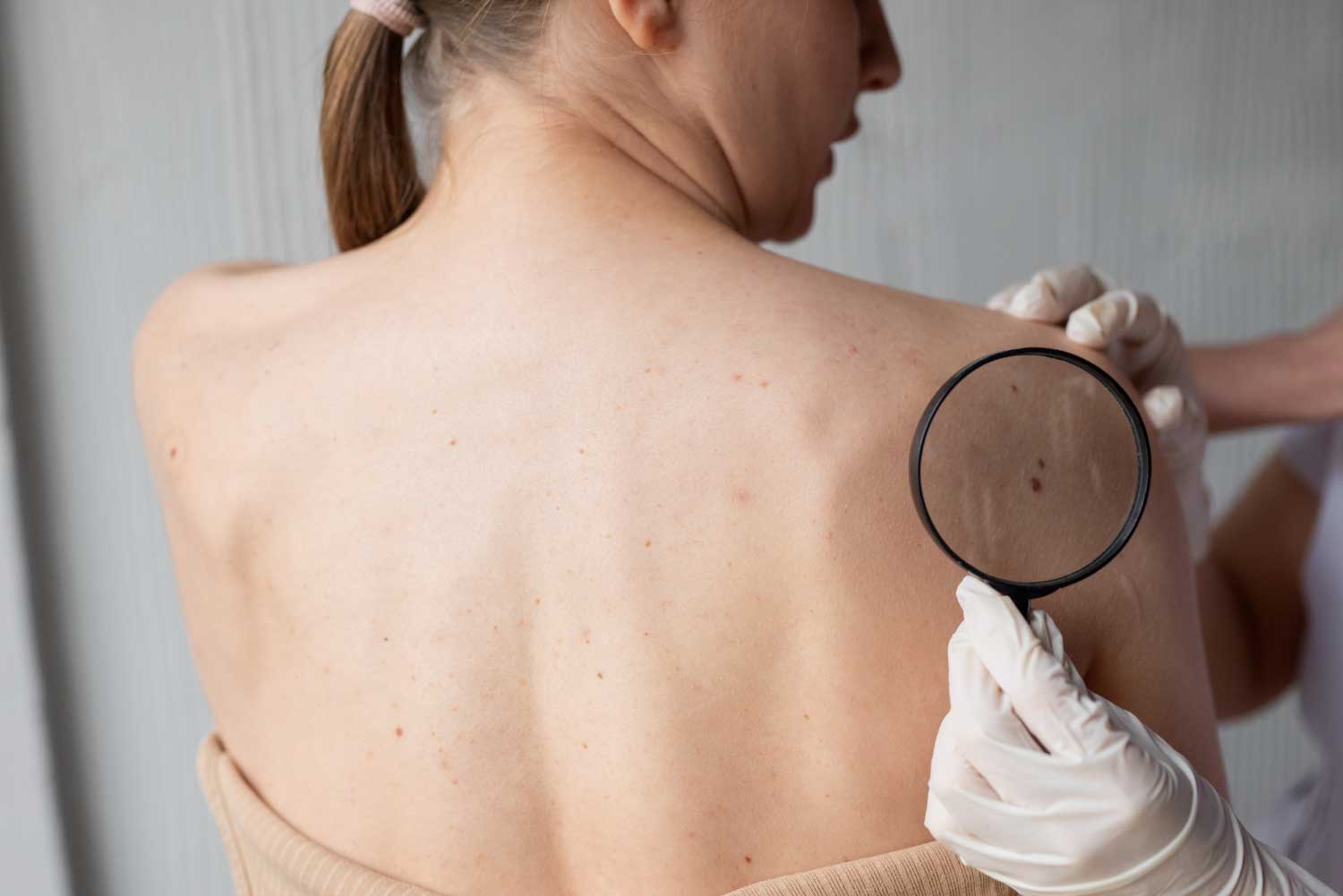 Female doctor diagnosing a melanoma on the body