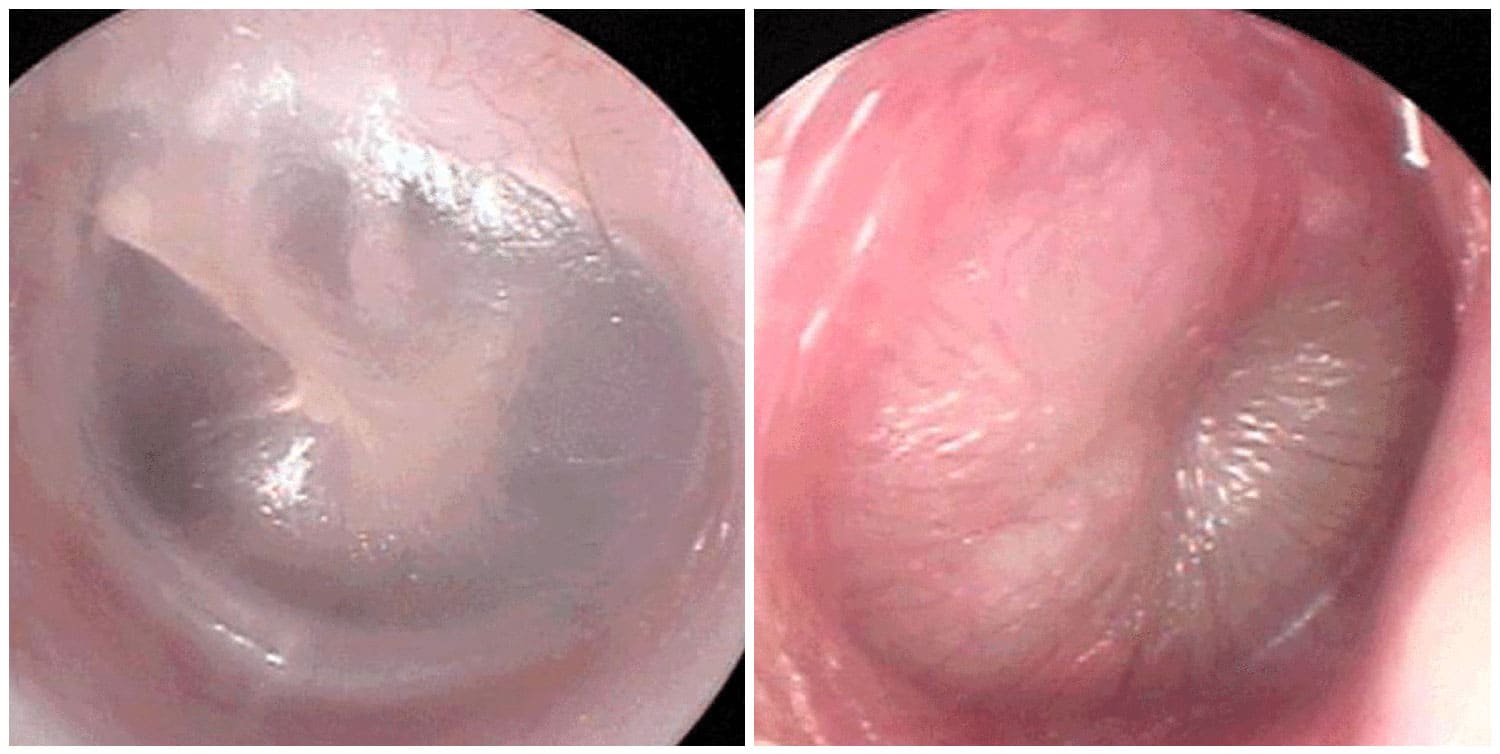 Images of eardrums from a healthy patient (left) or with acute otitis media (right) captured by the new smartphone app.