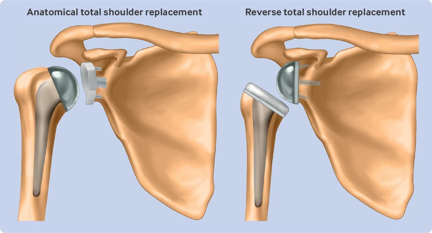 Anatomical total shoulder replacement
